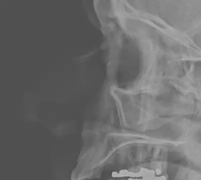 Radiograph from the case bank: Nasal bone fracture