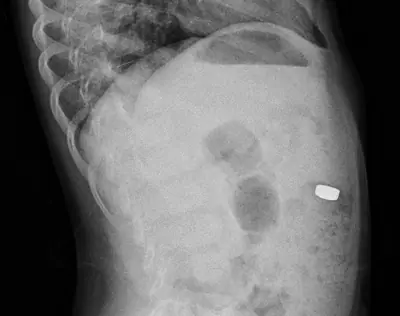 Radiograph from the case bank: Foreign body (ingested or inserted)