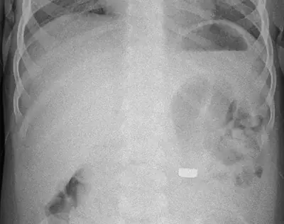 Radiograph from the case bank: Foreign body (ingested or inserted)