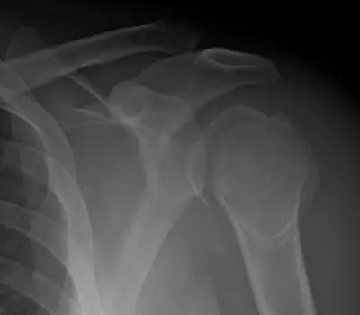 Radiograph from the case bank: Proximal humerus fracture