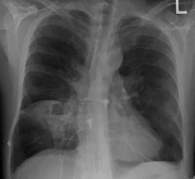 Radiograph from the case bank: Lung abscess