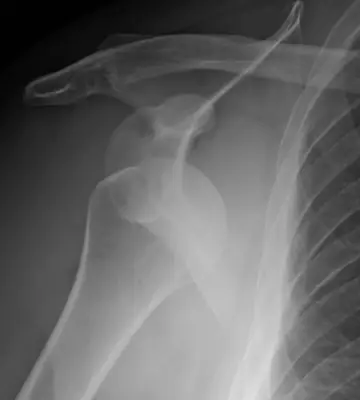 Radiograph from the case bank: Shoulder (glenohumeral) dislocation