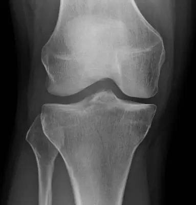 Radiograph from the case bank: Tibial plateau fracture