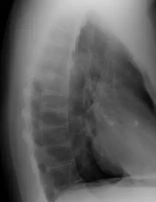 Radiograph from the case bank: Diffuse idiopathic skeletal hyperostosis (DISH)