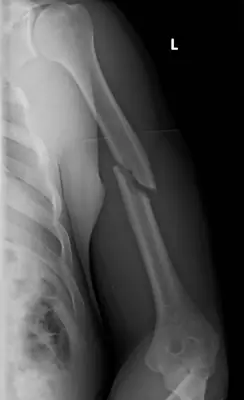 Radiograph from the case bank: Humeral shaft fracture