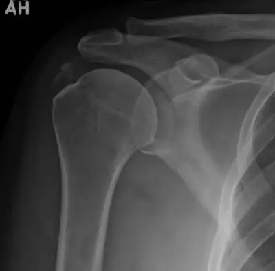Radiograph from the case bank: Calcific tendinitis