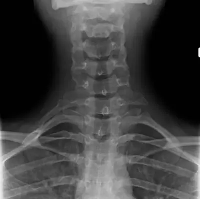 Radiograph from the case bank: Cervical rib