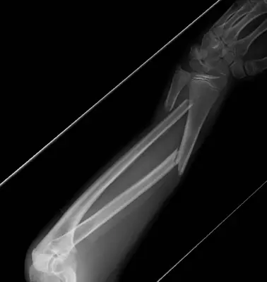 Radiograph from the case bank: Forearm shaft fracture (radius and ulna)