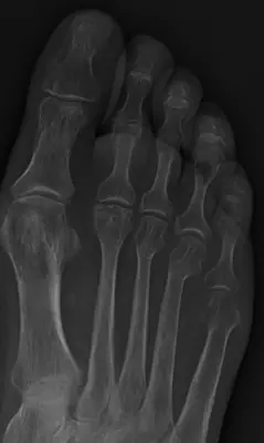Radiograph from the case bank: Freiberg disease