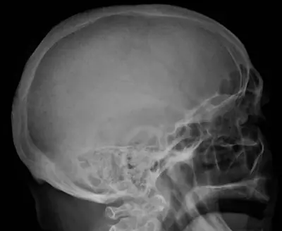 Radiograph from the case bank: Multiple myeloma