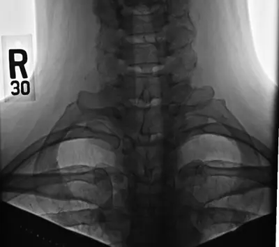 Radiograph from the case bank: Cervical rib