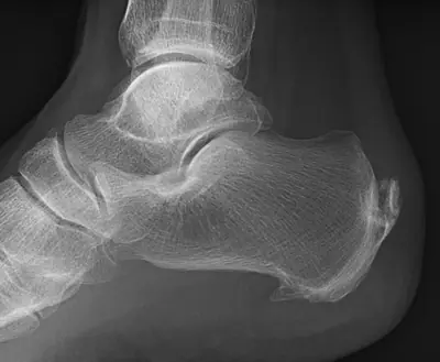Radiograph from the case bank: Calcaneal spur
