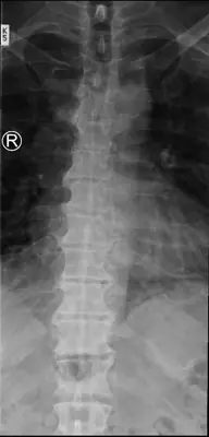 Radiograph from the case bank: Diffuse idiopathic skeletal hyperostosis (DISH)