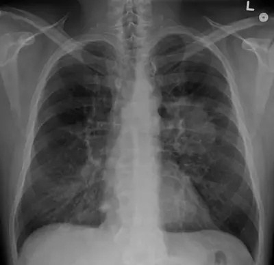 Radiograph from the case bank: Lung cancer (mass)