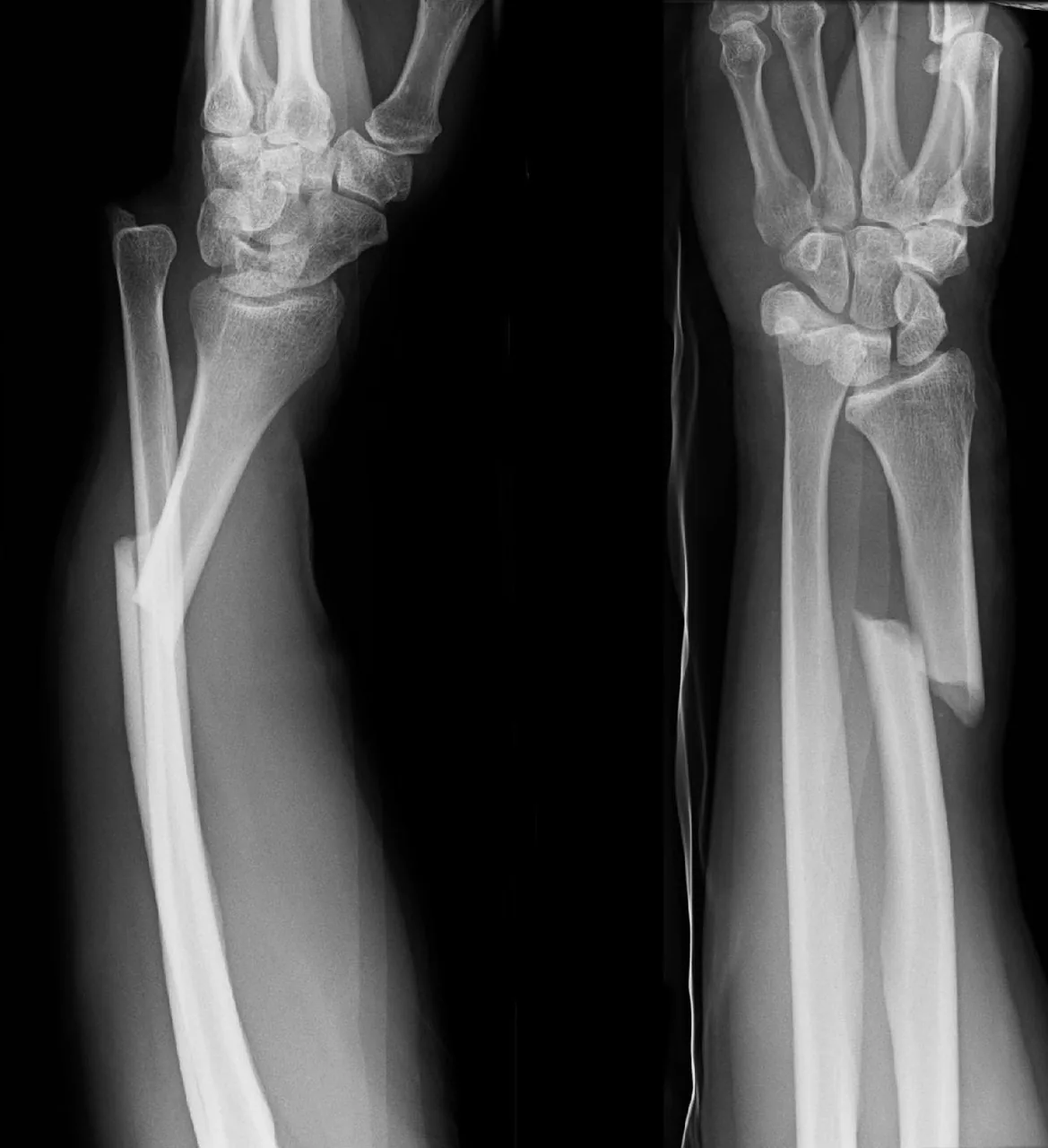 Upper limb radiograph for self-assessment