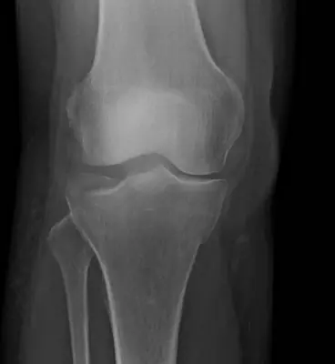 Radiograph from the case bank: Tibial plateau fracture