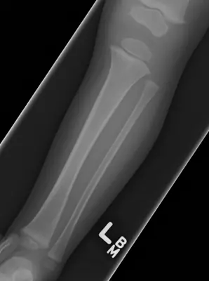 Radiograph from the case bank: Tibial (and fibular) shaft fracture