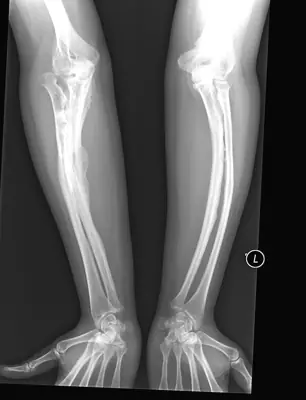 Radiograph from the case bank: Osteogenesis imperfecta