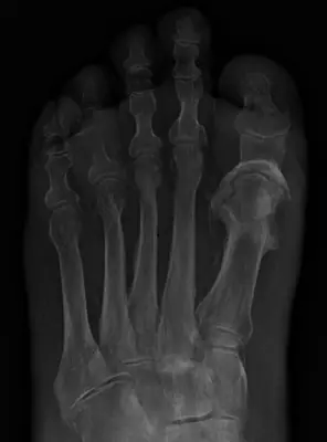 Radiograph from the case bank: Osteomyelitis