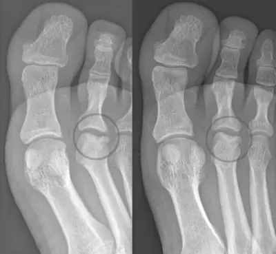 Radiograph from the case bank: Freiberg disease