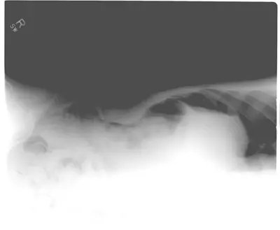 Radiograph from the case bank: Pneumoperitoneum (free intraperitoneal gas)