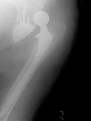 Radiograph from the case bank: Hip dislocation