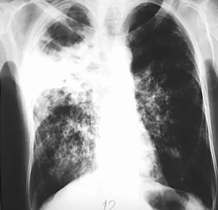 Chest radiograph for self-assessment