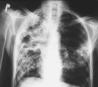 Chest radiograph for self-assessment