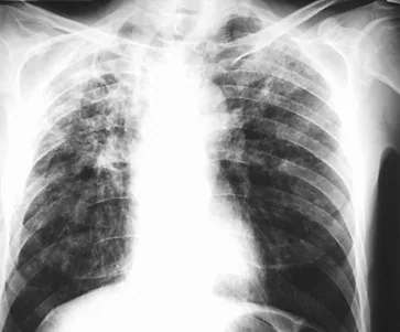 Chest radiograph for self-assessment