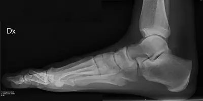 Radiograph from the case bank: Normal foot radiograph