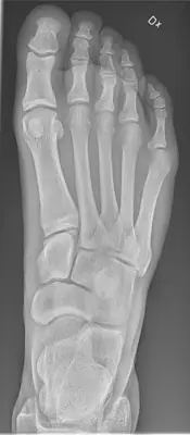 Radiograph from the case bank: Normal foot radiograph
