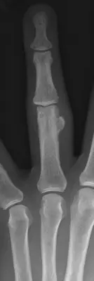 Radiograph from the case bank: Osteochondroma (exostosis)