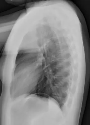 Radiograph from the case bank: Normal chest radiograph