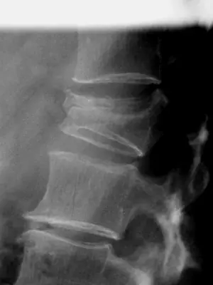 Radiograph from the case bank: Lumbar vertebral fracture