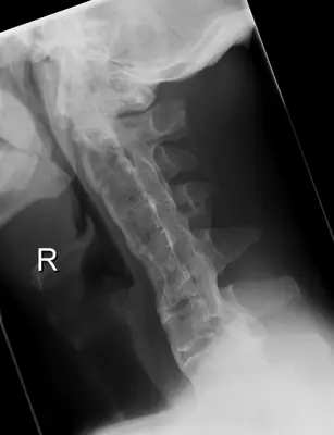 Radiograph from the case bank: Ankylosing spondylitis