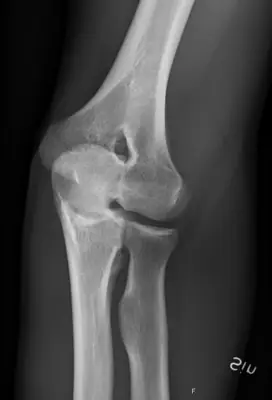 Radiograph from the case bank: Normal elbow radiograph