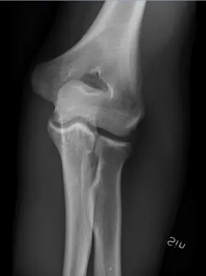 Radiograph from the case bank: Normal elbow radiograph