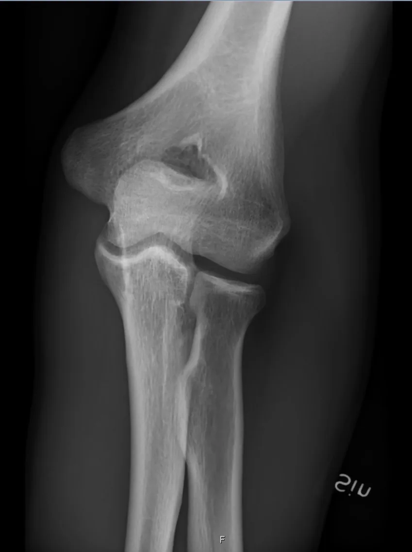 Upper limb radiograph for self-assessment