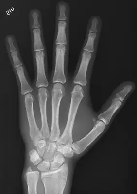 Radiograph from the case bank: Normal hand radiograph