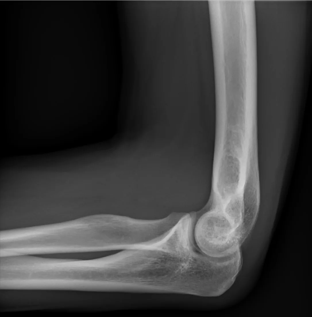 Upper limb radiograph for self-assessment