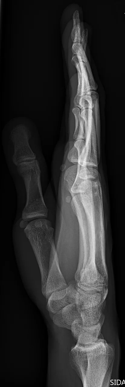 Upper limb radiograph for self-assessment