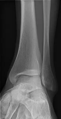 Radiograph from the case bank: Normal ankle radiograph