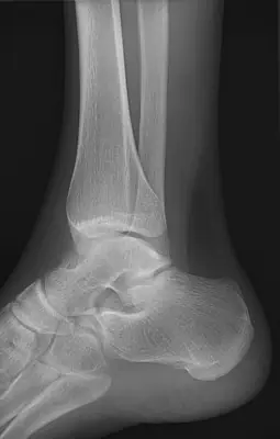 Radiograph from the case bank: Normal ankle radiograph