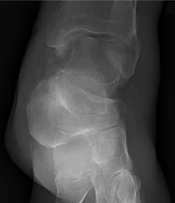 Radiograph from the case bank: Calcaneal fracture