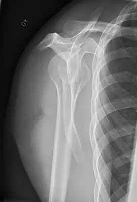 Radiograph from the case bank: Normal shoulder radiograph