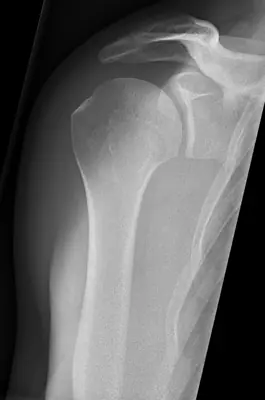 Radiograph from the case bank: Normal shoulder radiograph