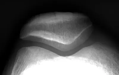Radiograph from the case bank: Normal knee radiograph