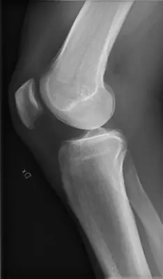 Radiograph from the case bank: Normal knee radiograph