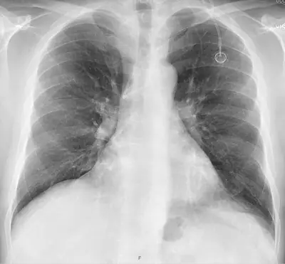 Radiograph from the case bank: Implanted venous access port (port-a-cath)