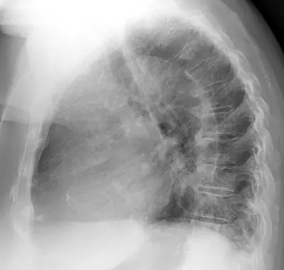 Radiograph from the case bank: Pneumonia (consolidation)